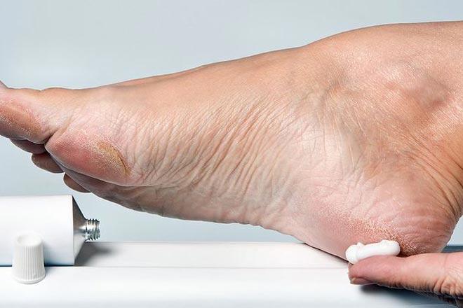 Les meilleures crèmes pour les talons fissurés selon les avis des clients La meilleure crème pour les talons craquelés